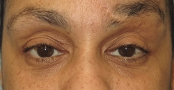 Do You Need Tear Trough Filler or a Blepharoplasty? - Brian S